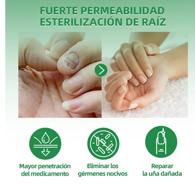 Nail Fungus™ Gotas para Hongos de Uñas Tratamiento de 7 días