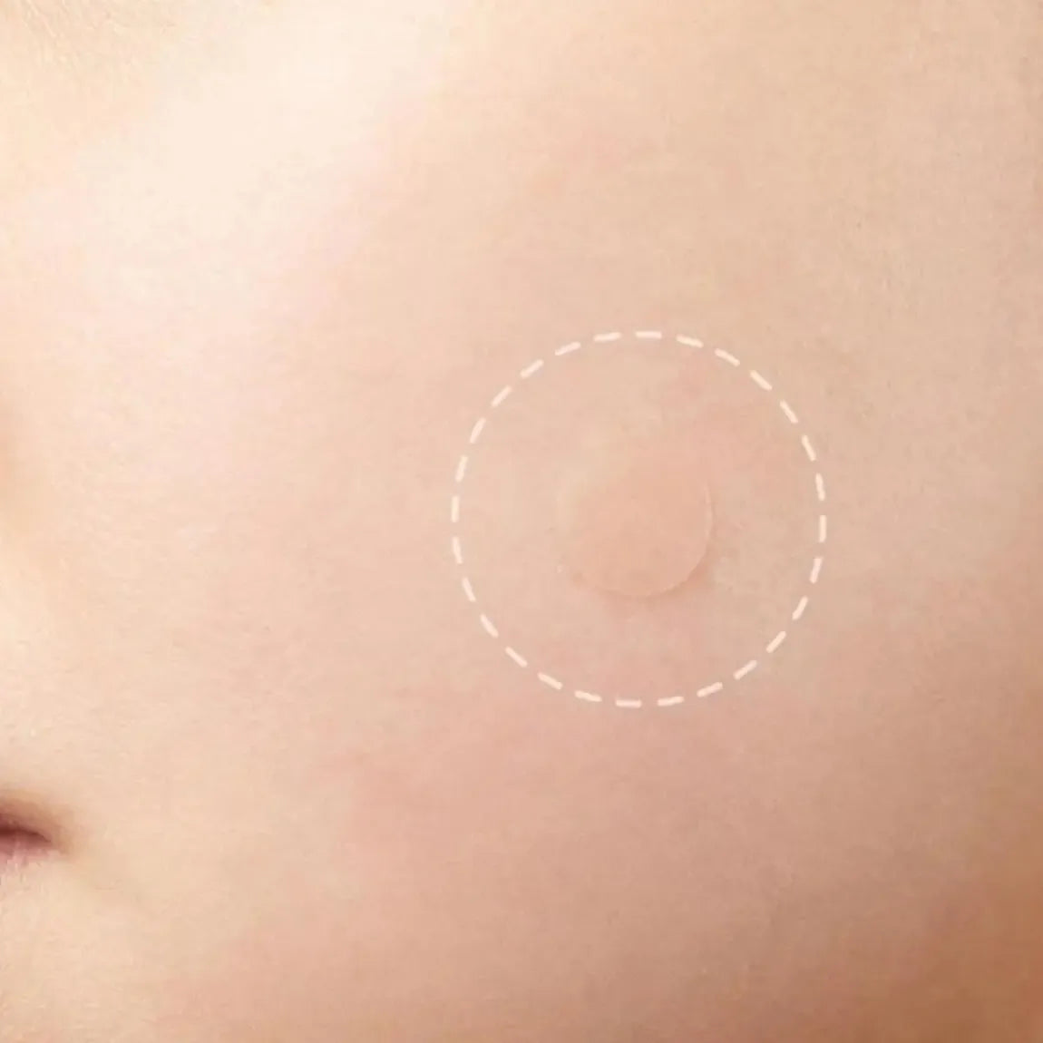 Acne Patch™ Parches Invisibles para Acné sin Dejar Marcas