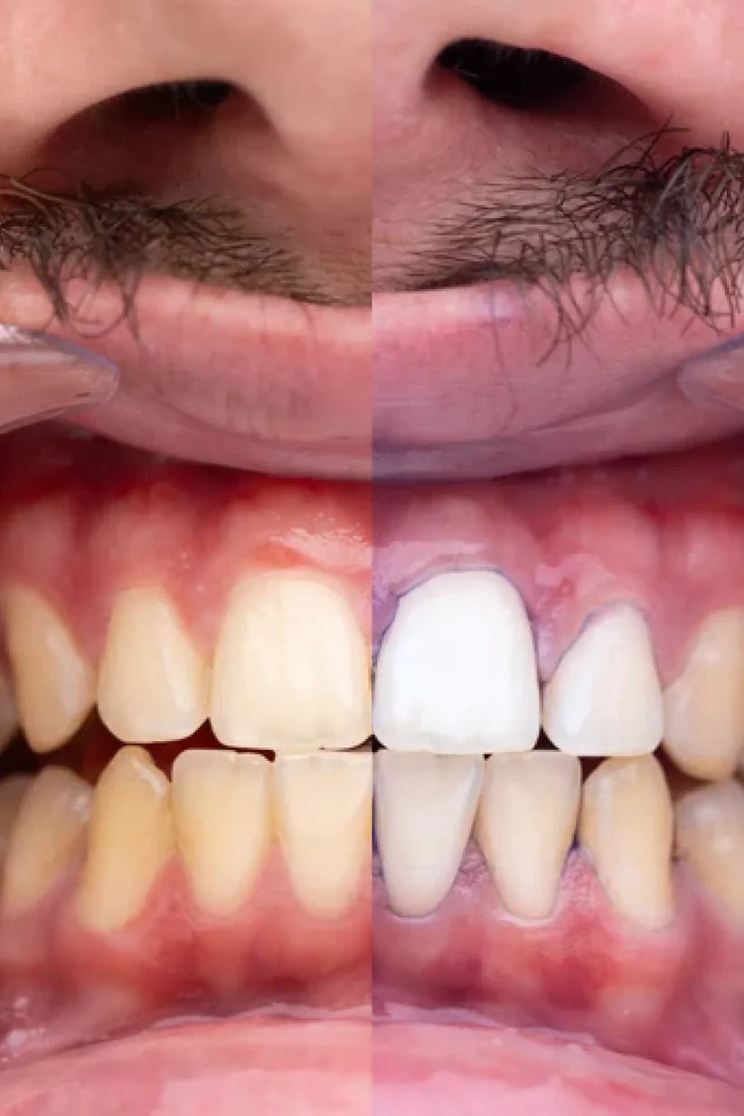 Hismile V34™ Luce una sonrisa más blanca al instante